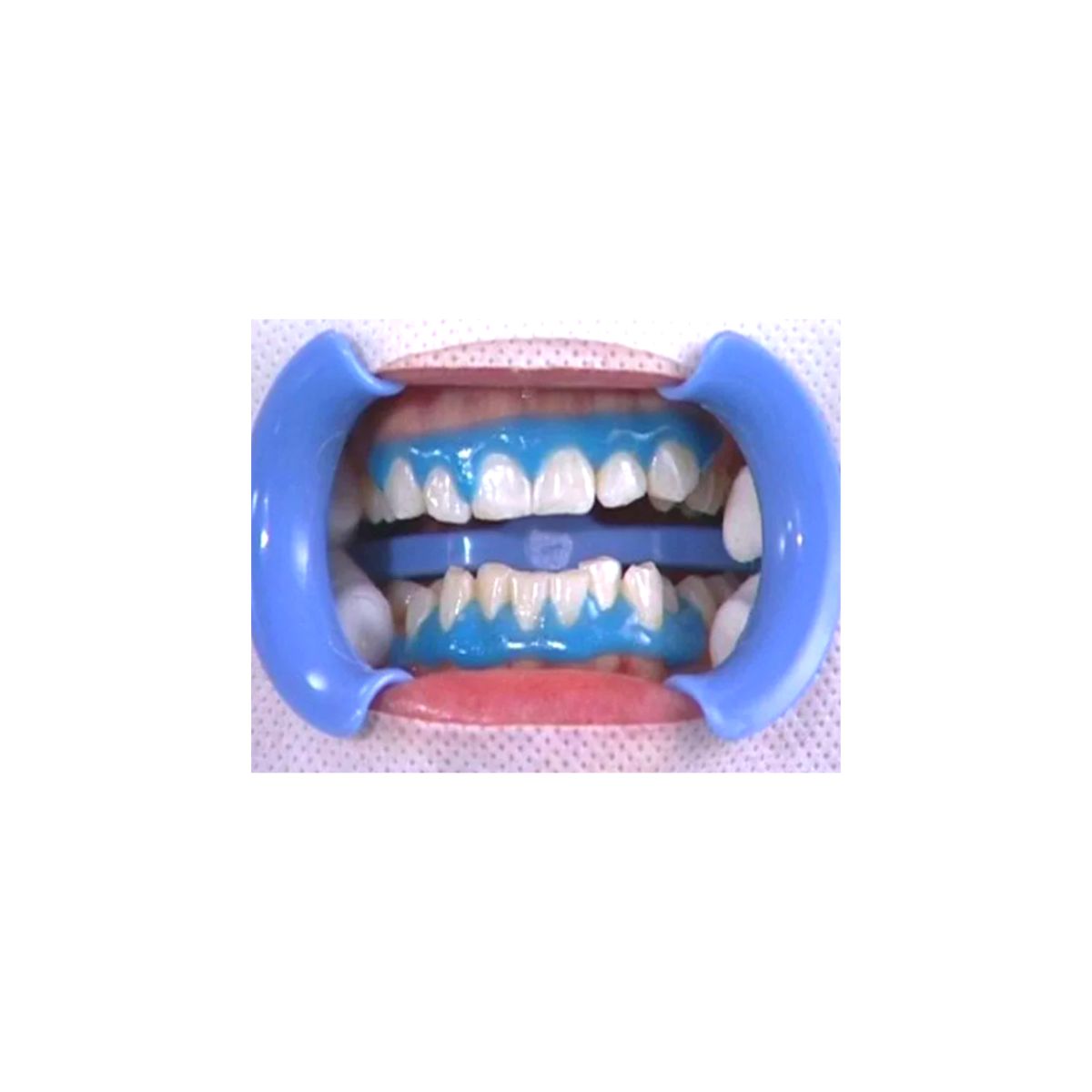gingival barrier applied to gums